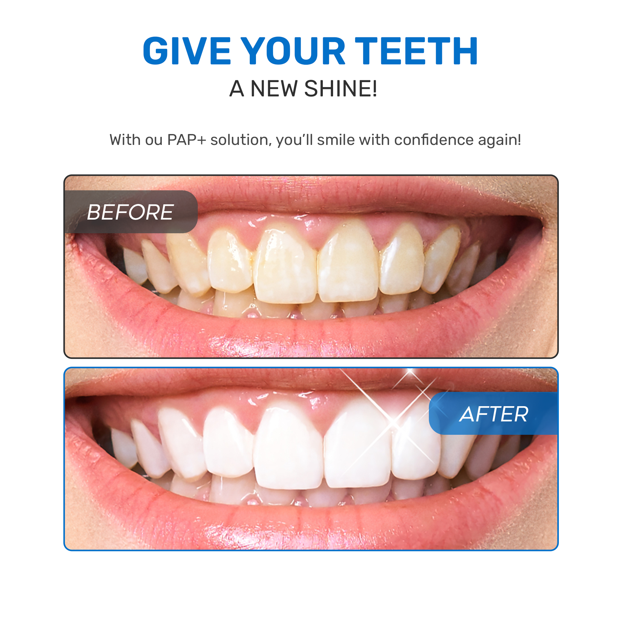 Kit per lo sbiancamento dei denti